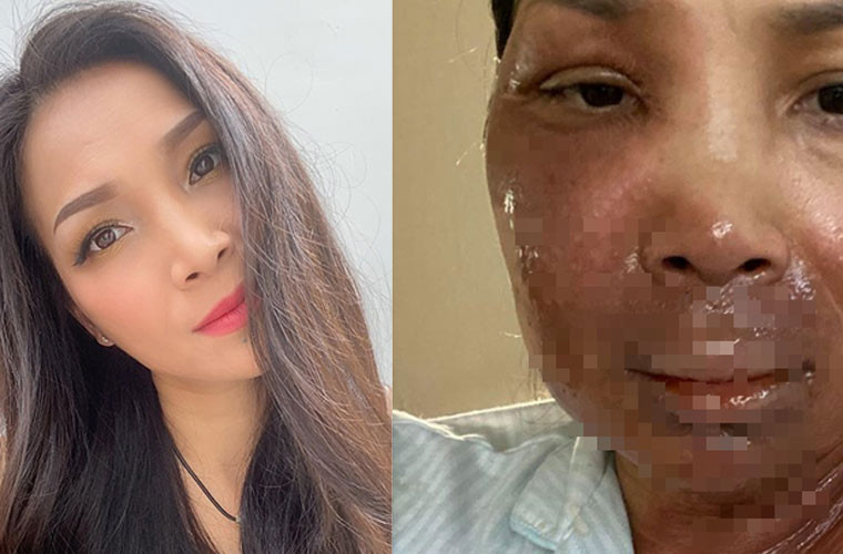 Tối 23/5, trên trang cá nhân, Hồng Ngọc đăng bức ảnh cô bị bỏng hơn nửa khuôn mặt do nồi xông hơi, khiến ai nhìn thấy cũng xót xa.