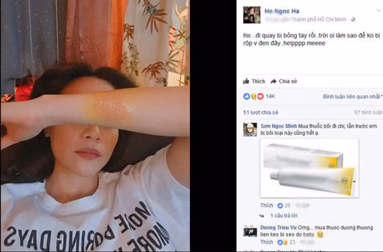 Hồ Ngọc Hà cũng bị bỏng ở tay trong một lần đi quay. Vết bỏng ở phía dưới tay khiến giọng ca Tìm lại giấc mơ lo lắng bị sẹo.