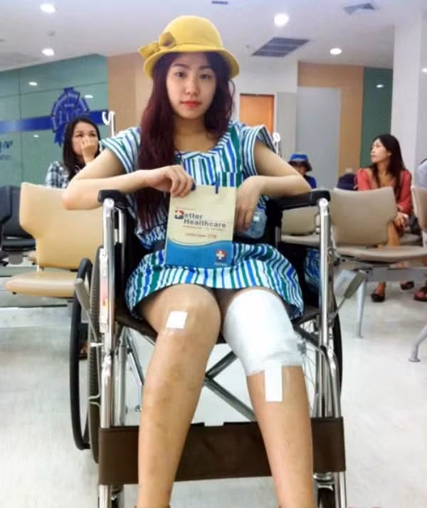 Nữ ca sĩ Lương Bích Hữu từng bị tai nạn bỏng nặng ở hậu trường sân khấu khi đi lưu diễn tại Phan Thiết.