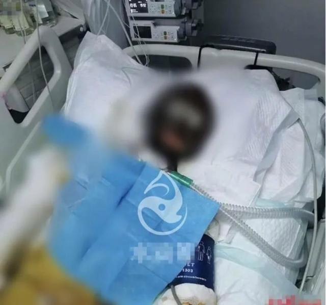 Lạp Mẫu nằm trong viện với vết bỏng chiếm 90% cơ thể.