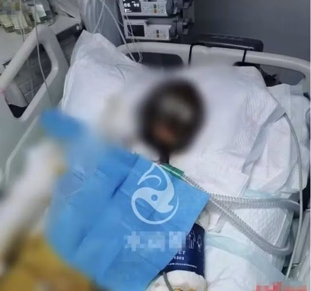 Lạp Mẫu nằm trong viện với vết bỏng chiếm 90% cơ thể.