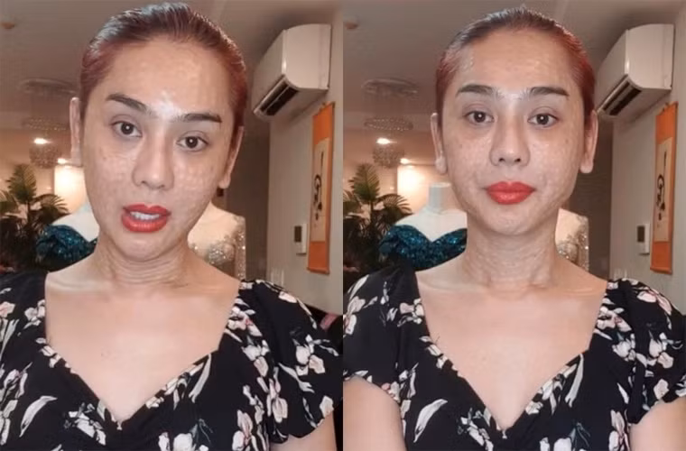 Giữa năm 2019, Lâm Khánh Chi khiến fan hoảng hốt khi xuất hiện với khuôn mặt sần sùi, lốm đốm, vùng cổ nhăn nheo trong một livestream. Tuy nhiên nữ ca sĩ cho biết, cô vừa đi làm đẹp vùng da mặt và da cổ.