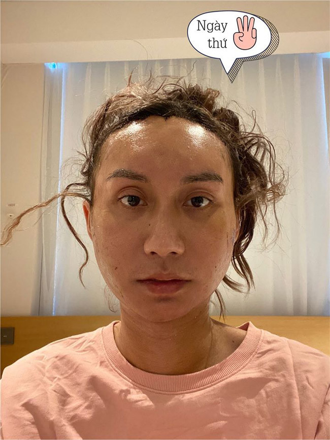 Ngày thứ 3 sau phẫu thuật thẩm mỹ.