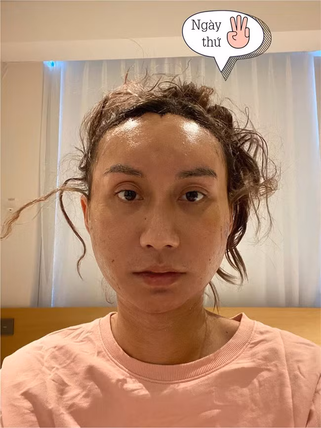 Ngày thứ 3 sau phẫu thuật thẩm mỹ.