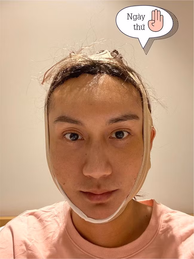 Ngày thứ tư sau phẫu thuật thẩm mỹ.