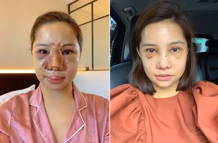 Năm 2019, Lưu Đê Ly lại trở thành đề tài của cộng đồng mạng khi công khai đã phẫu thuật thẩm mỹ lại toàn bộ khuôn mặt, từ hạ gò má, nâng mũi, trượt cằm, căng chỉ, cấy mỡ tự thân.