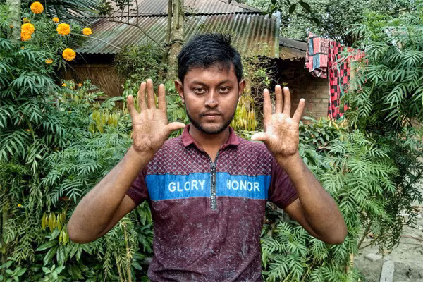 Hội chứng không có dấu vân tay khiến nhiều người khốn khổ Hoi chung khong co dau van tay khien nhieu nguoi khon kho