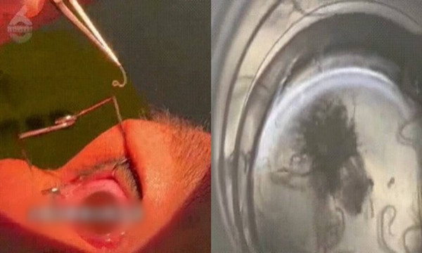 Dang dui mat thay giun roi ra, co gai kinh so vi benh nay