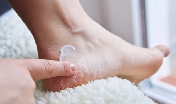 Cach tri tan goc benh nut got chan vao mua dong cuc chuan