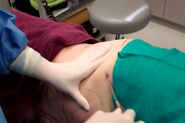 Nguoi phu nu nhap vien cap cuu vi hut mo bung tai tham my vien