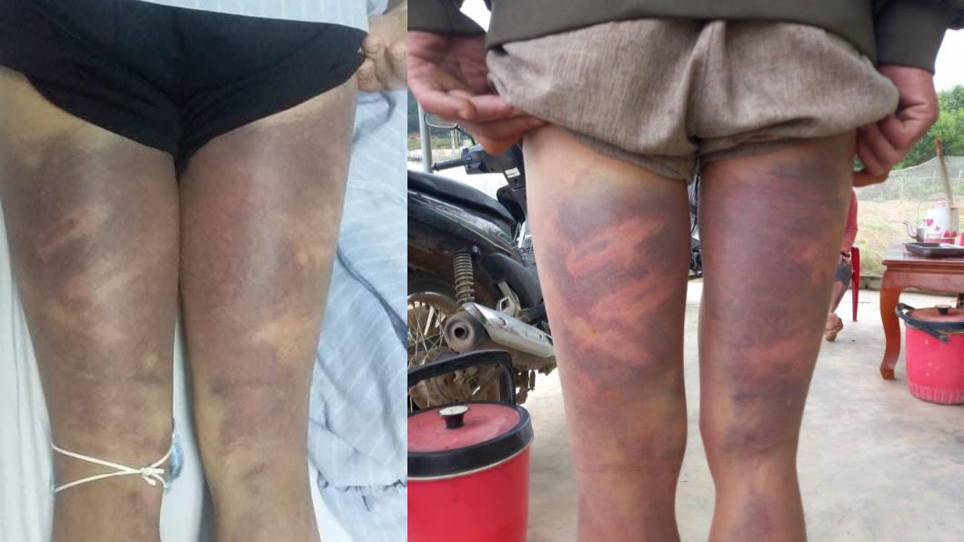  Một người dân nhập viện sau khi về từ trụ sở Công an xã: Ngày 21/3, UBND tỉnh Nghệ An cho biết, UBND tỉnh này vừa nhận được đơn của bà Nguyễn Thị Thạnh (ngụ xã Hiến Sơn, huyện Đô Lương) tố cáo ông Phạm Văn Quân - Công an viên và ông Phạm Văn Ngọc - Phó Công an xã Hiến Sơn có hành vi đánh người trái quy định pháp luật. 