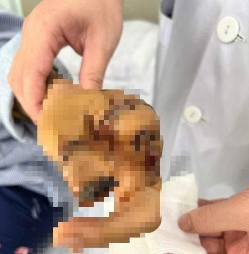 Cap cuu lam mom cut cho nguoi phu nu dap ban tay vi may xay thit-Hinh-2