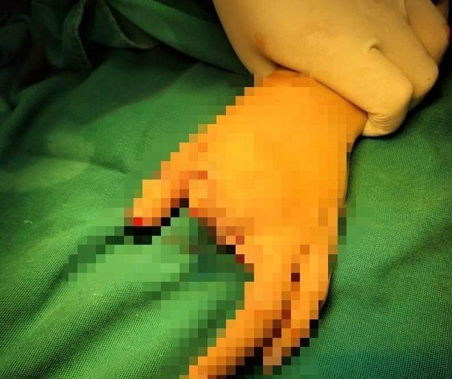 Cap cuu lam mom cut cho nguoi phu nu dap ban tay vi may xay thit