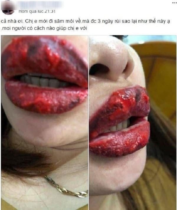 Ngoài ra cũng có một số trường hợp sử dụng mực xăm kém chất lượng dẫn đến môi bị nhiễm trùng.