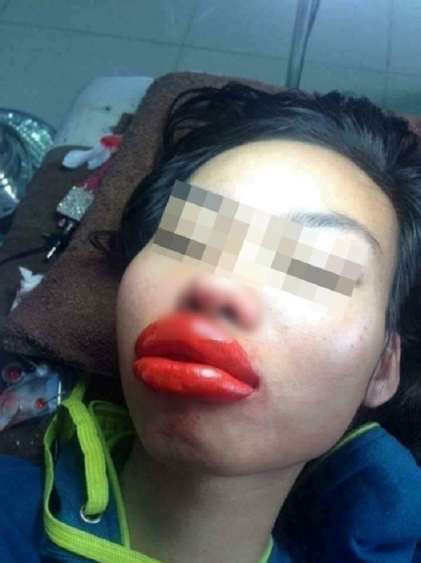 Có một số trường hợp chị em phải “kinh hồn bạt vía” vì đôi môi sưng vù như bị ong đốt của mình.