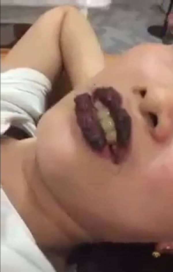 Có những trường hợp môi bong loang lổ, không đều màu. Nhìn những mảng da môi bị bong không khác gì màu tô của trẻ em khiến netizen chỉ biết “dở khóc dở cười”.