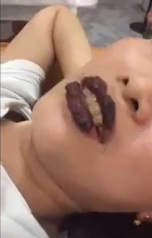 Có những trường hợp môi bong loang lổ, không đều màu. Nhìn những mảng da môi bị bong không khác gì màu tô của trẻ em khiến netizen chỉ biết “dở khóc dở cười”.