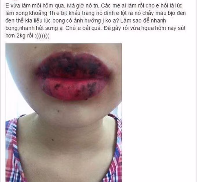 Nhiều người phải tới bệnh viện, mất rất nhiều thời gian và tiền bạc mới có thể trở về đôi môi bình thường trước khi xăm.