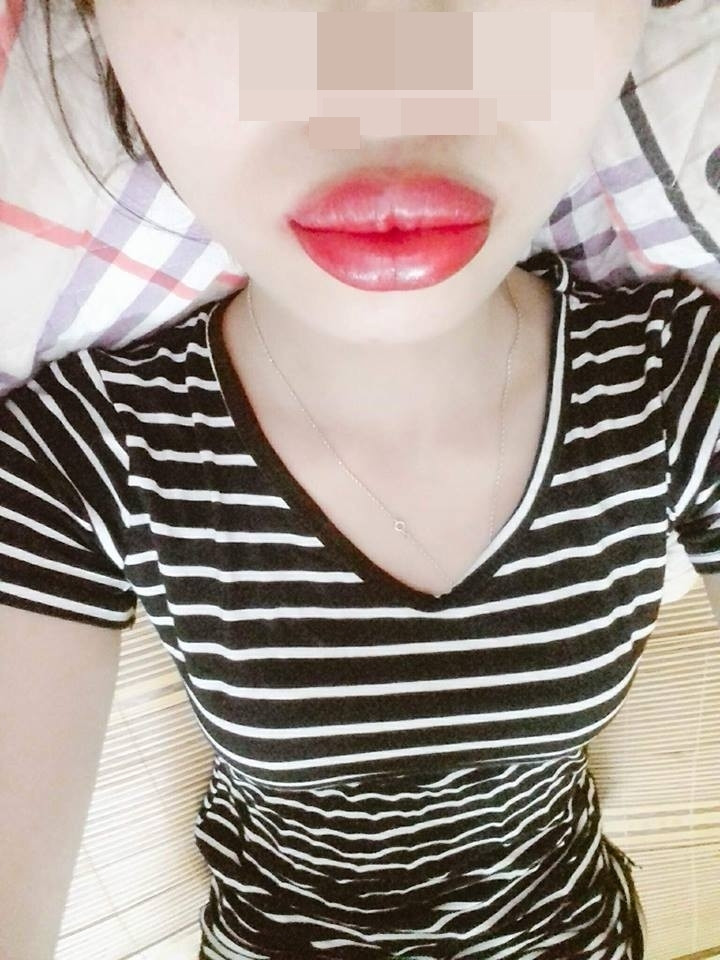 Hình ảnh đôi môi sưng vù khiến hội chị em ám ảnh.