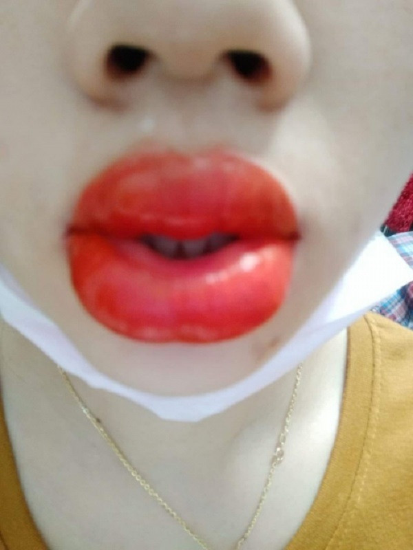 Môi sưng vù như ong đốt có lẽ là thảm họa xăm môi thường thấy. Tuỳ cơ địa của từng người sẽ có người bị sưng nhiều, có người bị sưng ít.