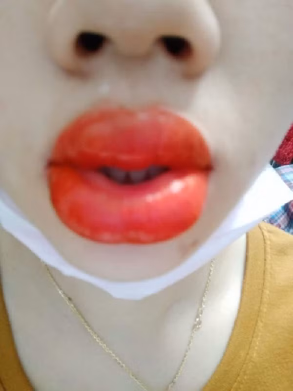 Môi sưng vù như ong đốt có lẽ là thảm họa xăm môi thường thấy. Tuỳ cơ địa của từng người sẽ có người bị sưng nhiều, có người bị sưng ít.