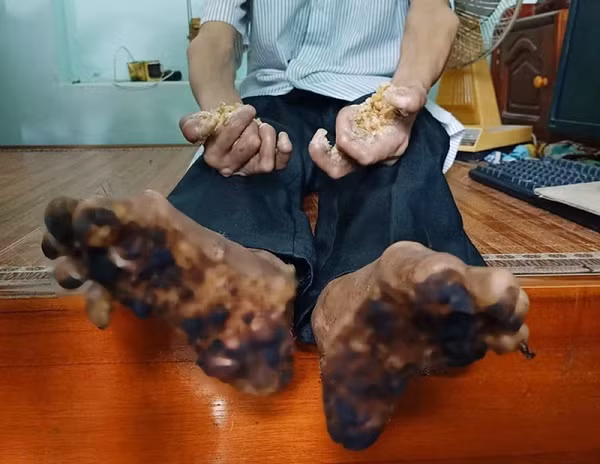 Việt Nam từng có 2 ca mắc căn bệnh tay chân hóa gỗ Viet Nam tung co 2 ca mac can benh tay chan hoa go