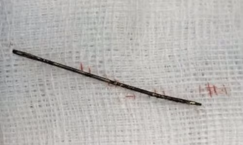 Phau thuat lay kim khau dai 4cm nam 2 nam trong nguc be gai