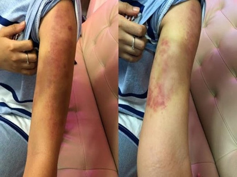 Phương Mỹ Chi từng uống thuốc giảm cân cấp tốc không rõ nguồn gốc khiến dạ dày bị co thắt. Cô còn móc họng ói, uống nước thay cơm khiến bị bệnh trào ngược dạ dày và xước cuống họng. Nữ ca sĩ còn áp dụng phương pháp “nào nhặn đốt mỡ” khiến hai bắp tay tím đen suốt 2 tháng.