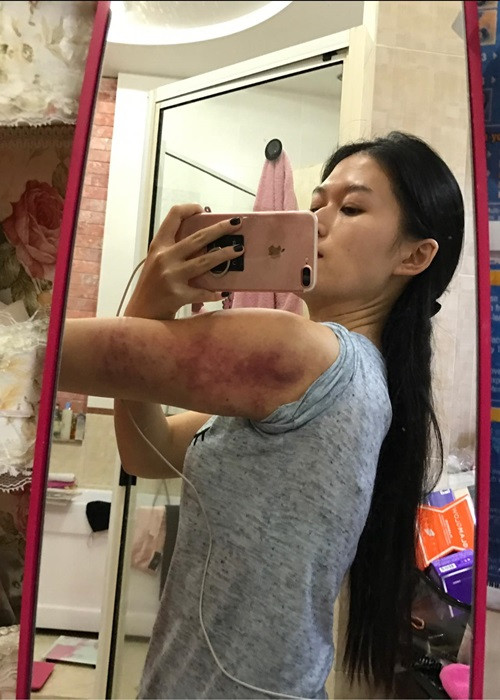 Mới đây, Ngọc Thanh Tâm chia sẻ hình ảnh cánh tay bầm tím. Cô thừa nhận giảm cân sai cách.