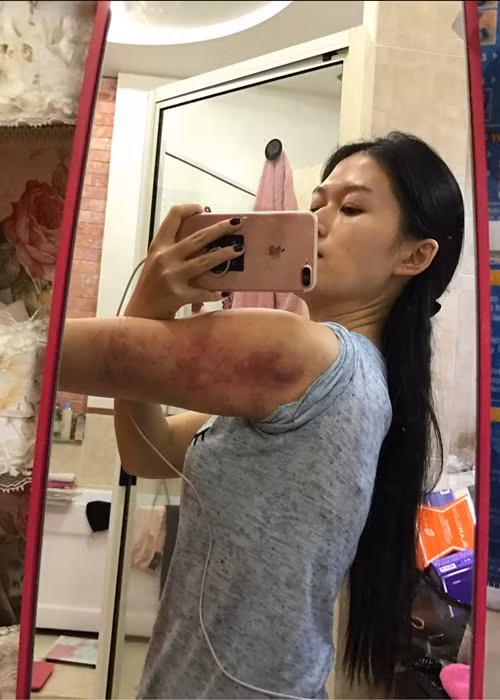 Mới đây, Ngọc Thanh Tâm chia sẻ hình ảnh cánh tay bầm tím. Cô thừa nhận giảm cân sai cách.