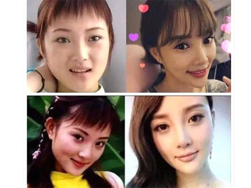 Trong những năm gần đây, Lý Tiểu Lộ liên tục vướng nghi vấn phẫu thuật thẩm mỹ bởi gương mặt khác xa so với trước kia.