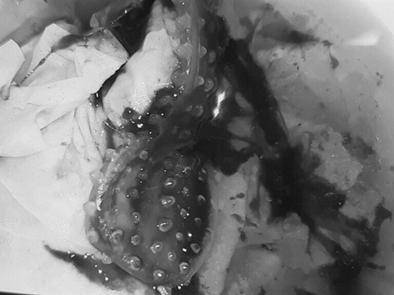 Xau ho khong den benh vien som, co gai phai len ban mo lay bao cao su