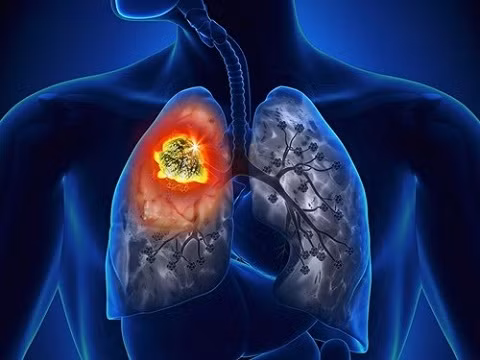Những dấu hiệu sớm cảnh báo bệnh ung thư phổi Nhung dau hieu som canh bao benh ung thu phoi