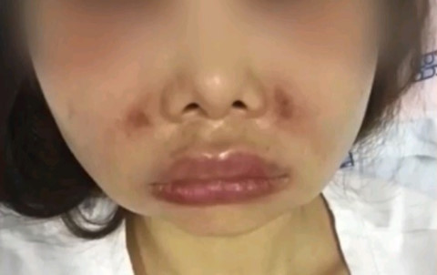 Người phụ nữ này gặp biến chứng nghiêm trọng sau 1 tuần tiêm chất làm đầy vùng môi, tạo rãnh cười, thon gọn cằm tại một spa trên đường Khánh Hội, quận 4, TP.HCM.