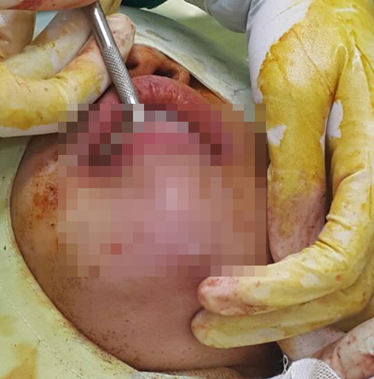 Chị N.T.H (30 tuổi, TP.HCM) sống trong tình trạng lo lắng, mất ăn mất ngủ vì phải chịu hậu quả do tiêm filler độn cằm. Bác sĩ phát hiện một khối có mật độ bất thường, không gây sưng đau nhưng âm thầm phá hủy mô bên trong. Chị H. được bác sĩ chỉ định phẫu thuật nạo, vét filler.