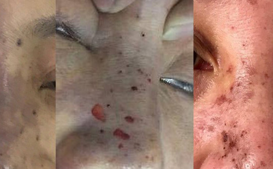 Nữ bệnh nhân 29 tuổi, ở TP.HCM, đã đến cầu cứu các bác sĩ vì bị hoại tử 2 bên má do tiêm chất làm đầy tại spa. Ba tháng sau khi tiêm, bệnh nhân bắt đầu có dấu hiệu nhiễm trùng, hoại tử vùng má, silicon vón cục lại và rò mủ ra bên ngoài.