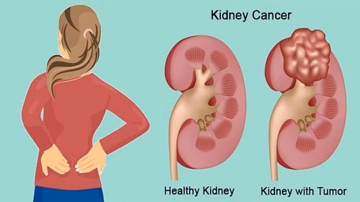 Ung thư: Theo một số nghiên cứu, giảm cân nhanh chóng bằng cách tước đi các chất dinh dưỡng của cơ thể cũng có thể kích hoạt một số loại ung thư, chẳng hạn như ung thư vú, ung thư thận, ung thư đại tràng,...