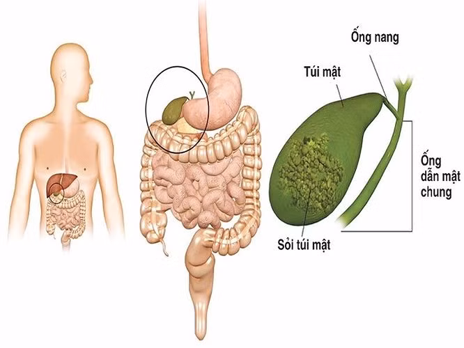 Sỏi mật: Sỏi mật là hệ quả của việc giảm cân không lành mạnh. Thông thường, sỏi mật có liên quan đến những người béo phì hoặc thừa cân. Tuy nhiên, trong một số trường hợp, khi mọi người giảm cân không lành mạnh bằng cách ăn kiêng và tập thể dục quá sức, mật không được thải ra khỏi cơ thể đúng cách. Điều này có thể làm cho mật trong gan cứng lại và hình thành các lớp đá, được gọi là sỏi mật. Tình trạng này có thể phải phẫu thuật!