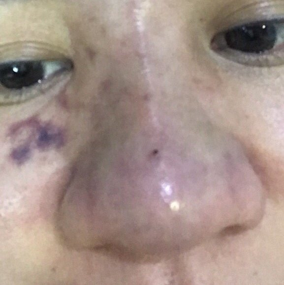 Lien tuc cap cuu bien chung tiem filler, bac si noi gi?