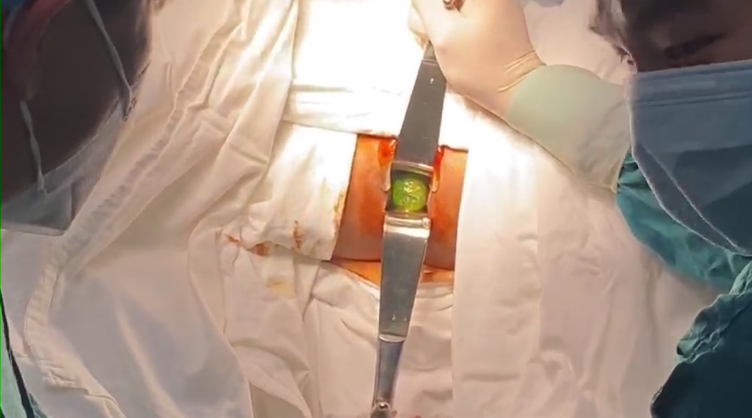 “Sửng sốt” với quả dưa leo trong hậu môn nam thanh niên thích cảm giác lạ - Hình 2 “Sung sot” voi qua dua leo trong hau mon nam thanh nien thich cam giac la-Hinh-2