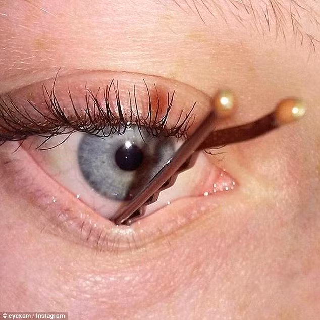 Chiếc kẹp tóc bằng kim loại được chủ nhân nhét vào trong hốc mắt.