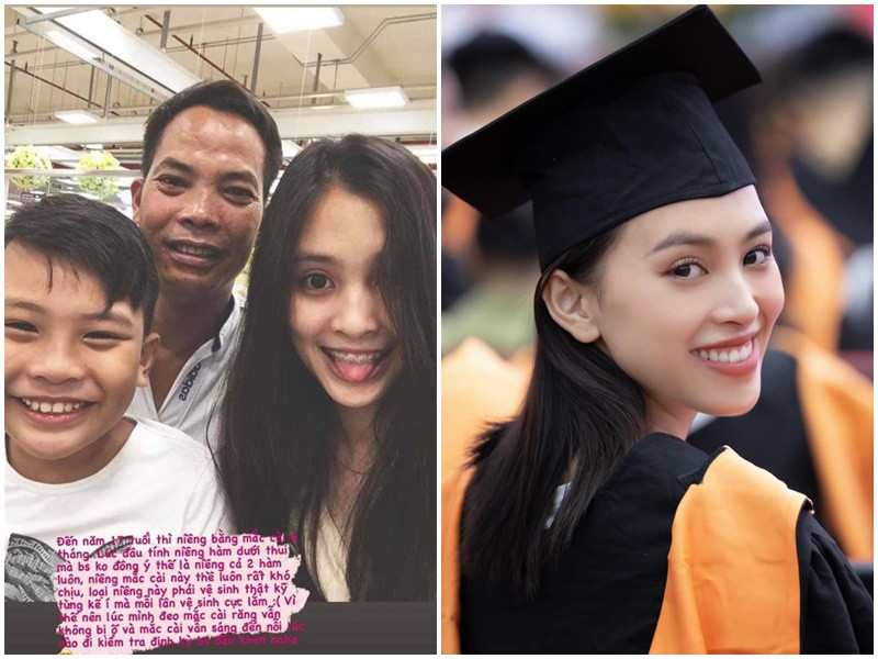 Hoa hậu Tiểu Vy cũng niềng răng để có nụ cười trắng sáng. Ảnh: FBNV, Vietnamnet.