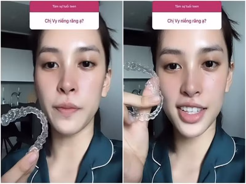 Cô niềng răng mắc cài sau đó niềng khay trong suốt. Ảnh: Vietnamnet.