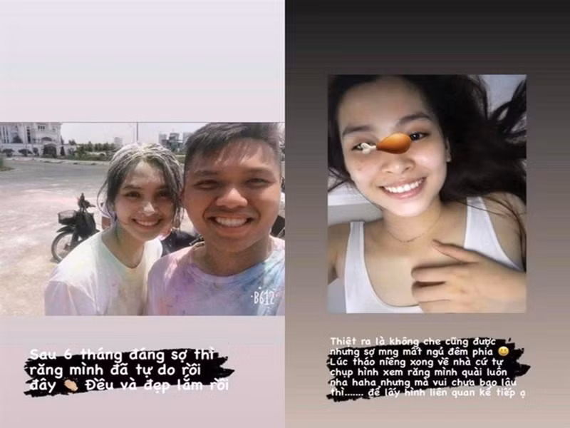 Hình ảnh Tiểu Vy có hàm răng đều sau một thời gian đeo niềng. Ảnh: Vietnamnet.