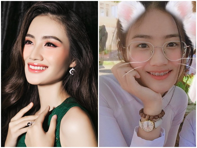 Hoa hậu Ý Nhi không ngần ngại chia sẻ những bức ảnh khi còn đeo niềng. Ảnh: FBNV.