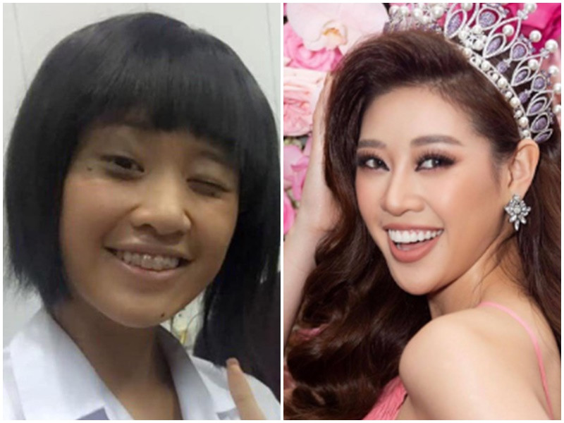 Niềng răng giúp gương mặt của Hoa hậu Khánh Vân trở nên cuốn hút hơn. Ảnh: Yan.