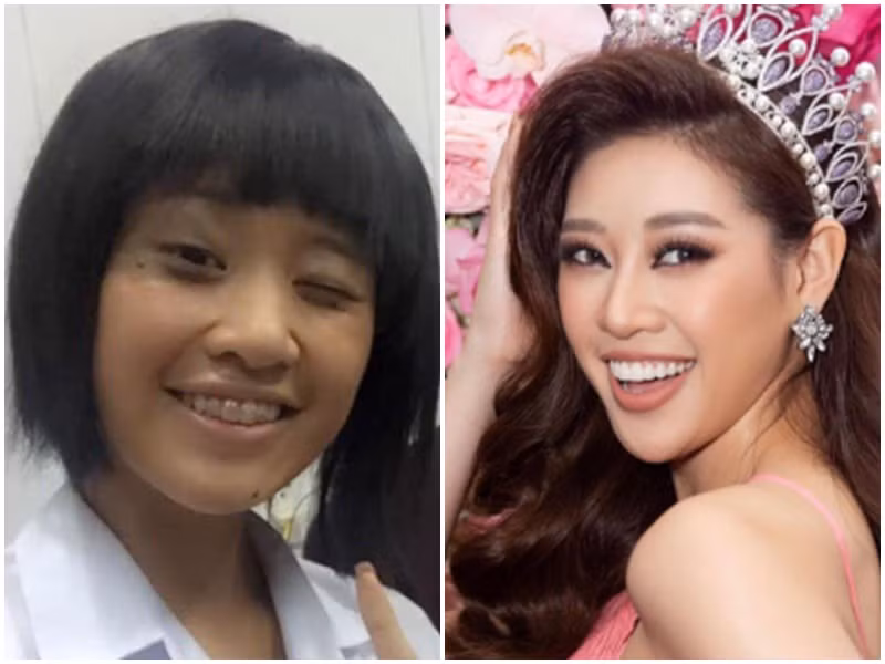 Niềng răng giúp gương mặt của Hoa hậu Khánh Vân trở nên cuốn hút hơn. Ảnh: Yan.