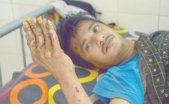 Anh Bajandar hy vọng các ca phẫu thuật cho đôi tay "của quỷ" thành công và căn bệnh này sẽ không bao giờ tái phát.