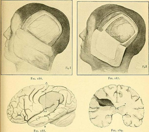 Các chuyên gia, nhà khoa học tiến hành nghiên cứu một hộp sọ nam được phát hiện tại khu mai táng Anzhevsky, đông nam Kanask, Nga. Kết quả nghiên cứu hé lộ bí mật "động trời": "Bác sĩ" từ hơn 3.000 năm trước đã làm phẫu thuật hộp sọ.