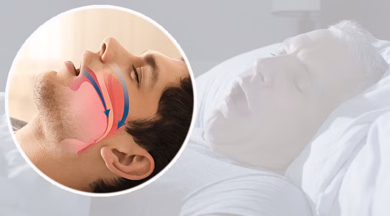 Khi tắc nghẽn nghiêm trọng, bạn có thể bị hội chứng ngưng thở khi ngủ.